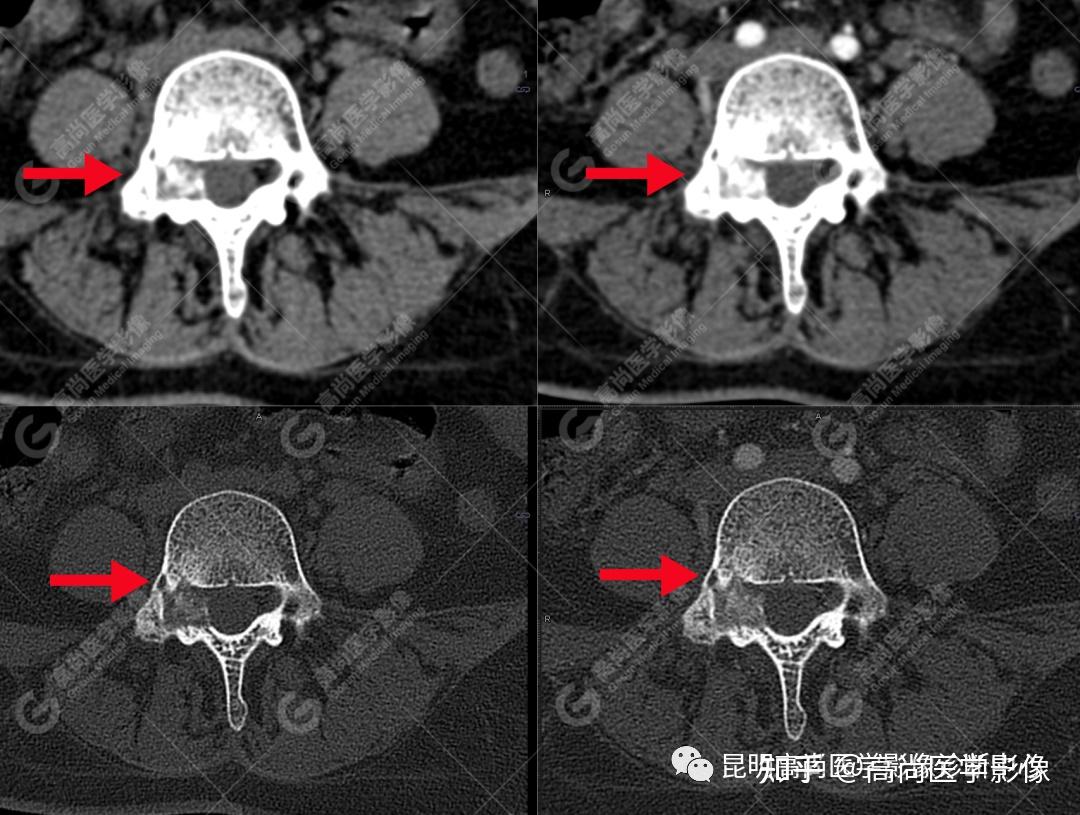 脊柱旁骨母细胞瘤病例分享高尚医学影像