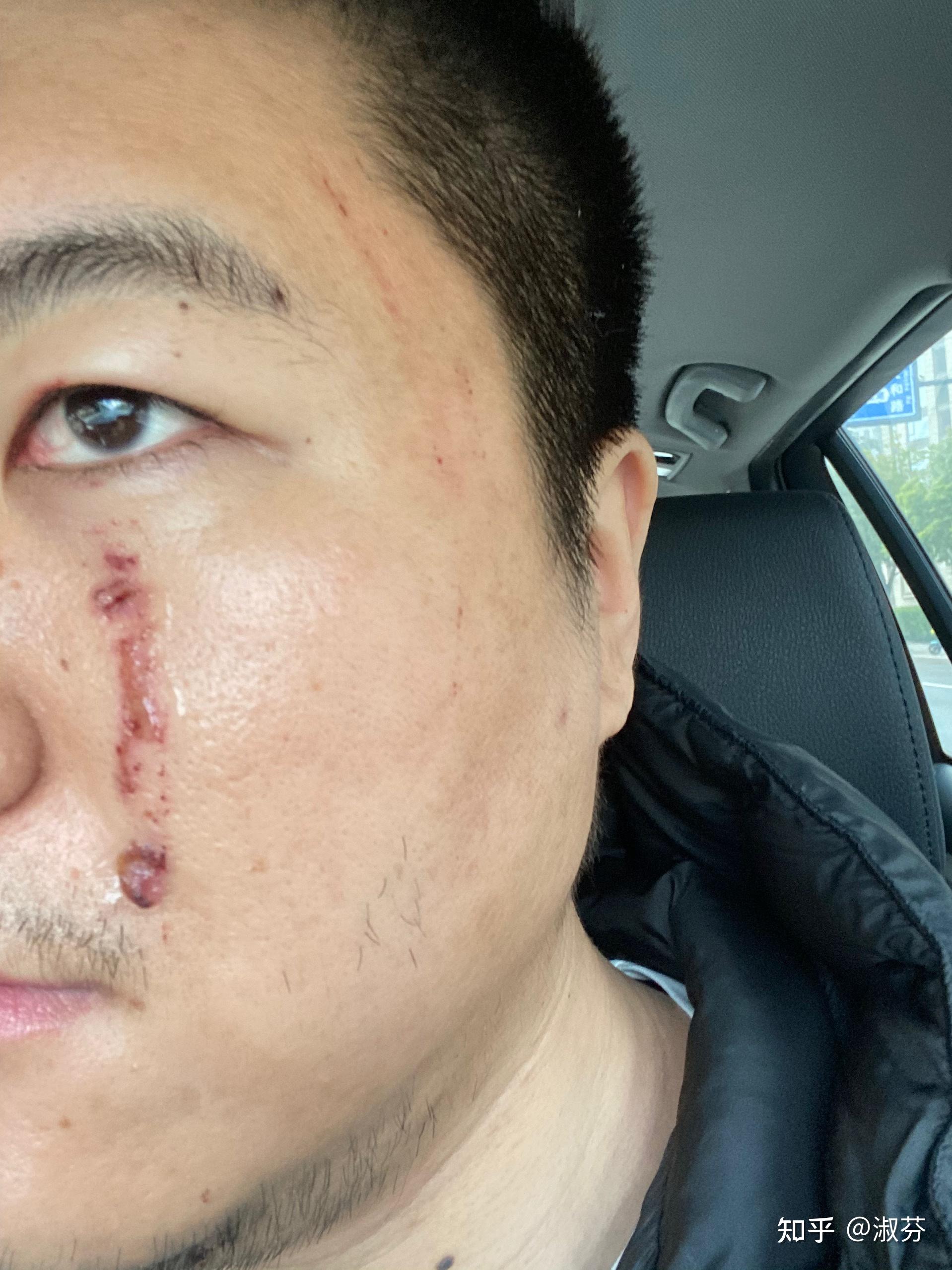 脸部受伤wahe凸起表面像脂肪粒能修复吗