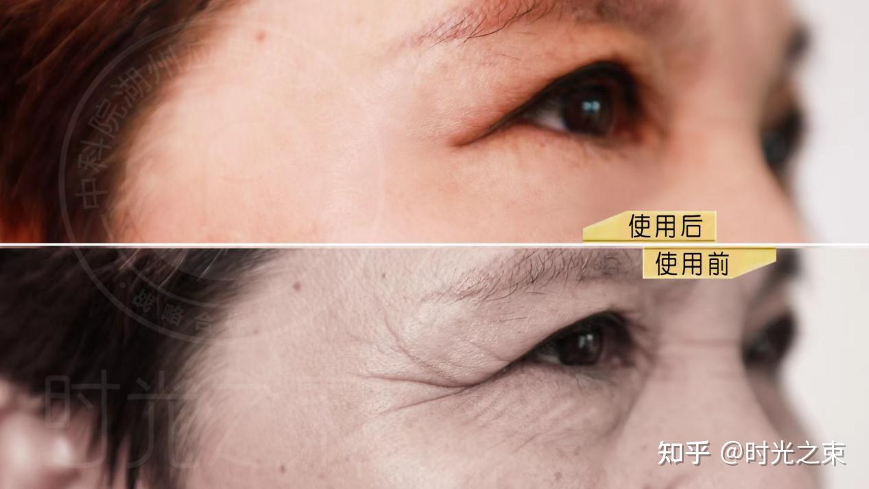 脸上有皱纹怎么办?时光之束从细节出发,重塑年轻肌! - 知乎