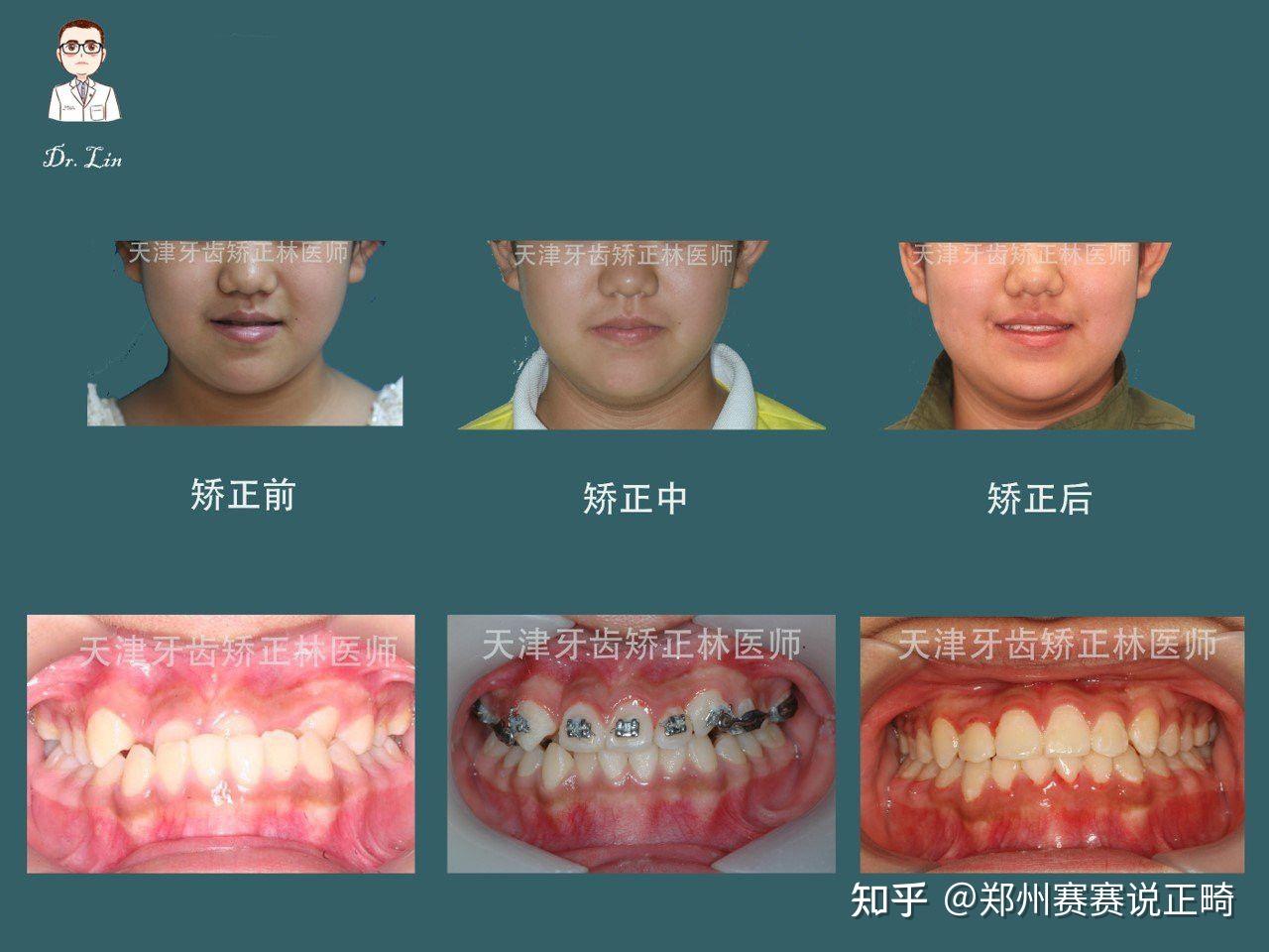 郑州牙齿矫正林范|有生长潜力的兜齿儿童需要双期治疗