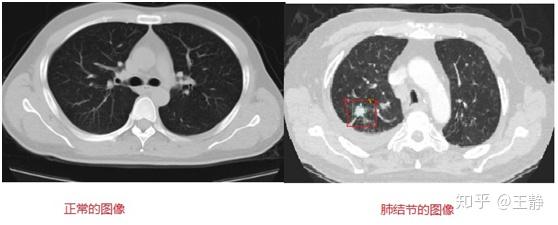 发现肺结节 用不用害怕 知乎 发现肺结节 用不用害怕 知乎