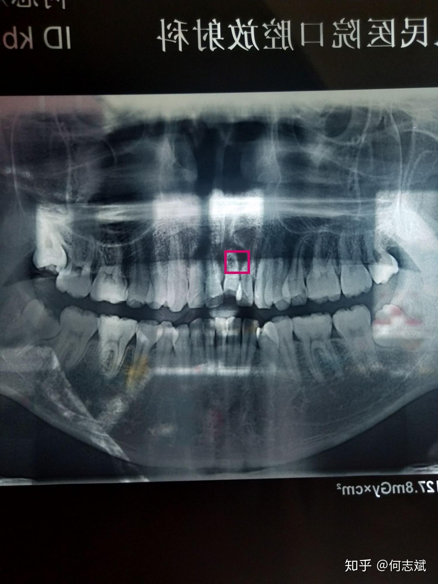 大连舌侧矫正：拔除左上门牙与侧切牙间的多生牙矫治牙齿拥挤 - 知乎