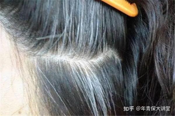 白发增多的人,一定要多刮刮这个地方! - 知乎