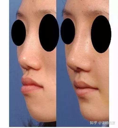 目前做的比较多的鼻基底通常指"垫鼻翼基底",也就是梨状孔周围的部位.