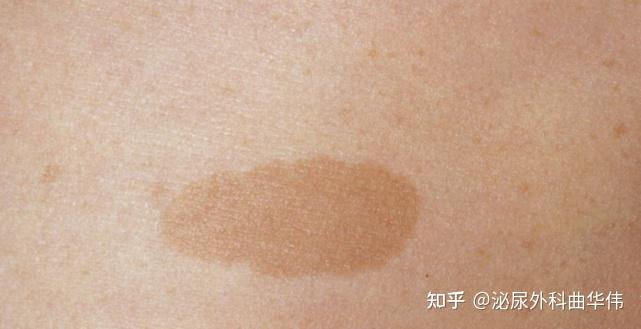 恶性肾上腺肿瘤有哪些症状?