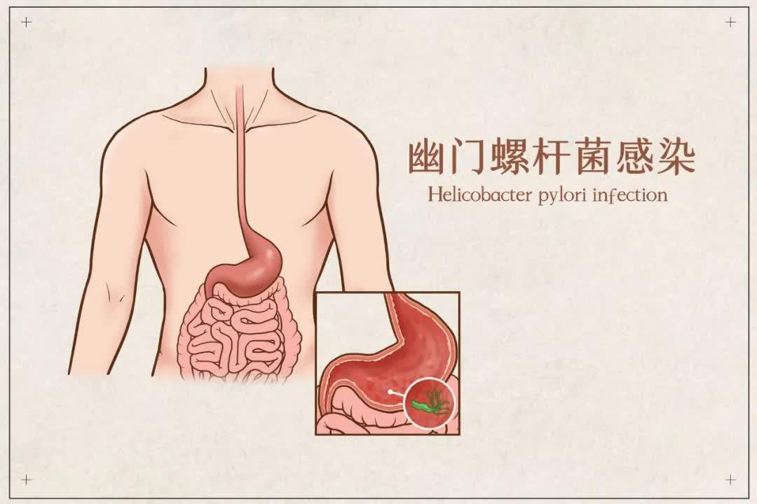 沒有症狀也有治療幽門螺桿菌感染藥知道