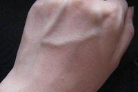 下肢静脉曲张是怎么回事别担心及时处理就不是事