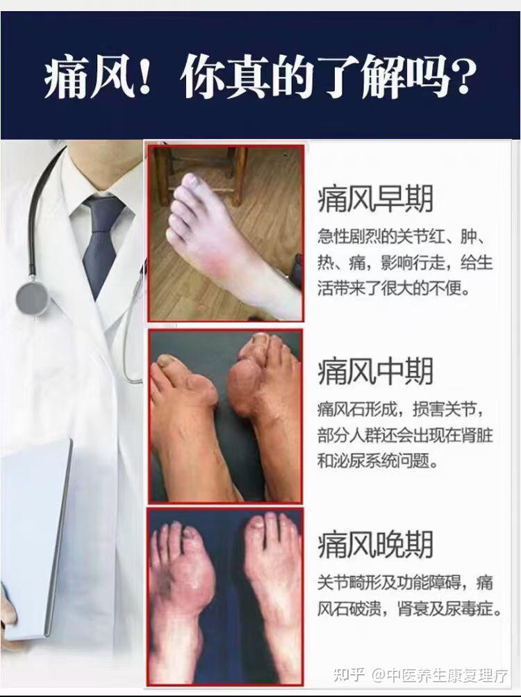 调理痛风
