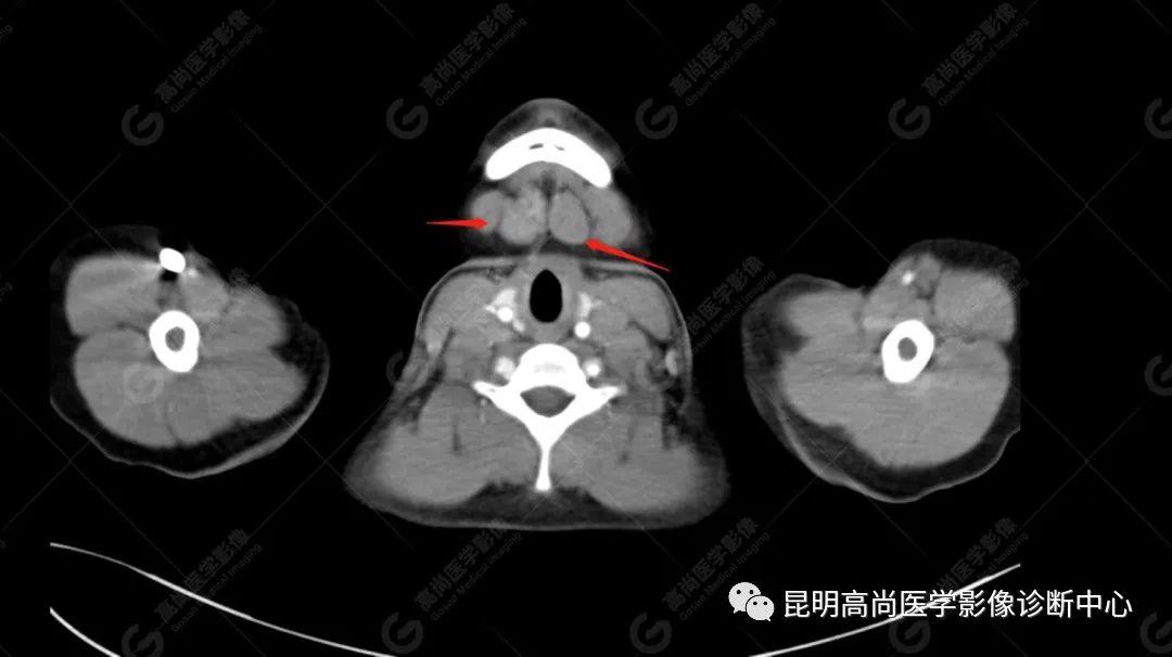一针辨真伪——超声引导下颈部淋巴结穿刺活检1例