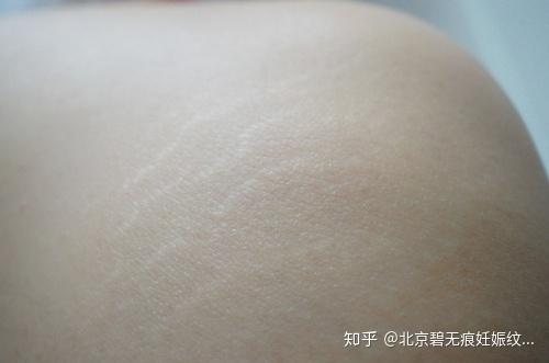 生长纹又称膨胀纹,是由于肾上腺分泌过盛,人体的肾上腺皮质能分泌一种
