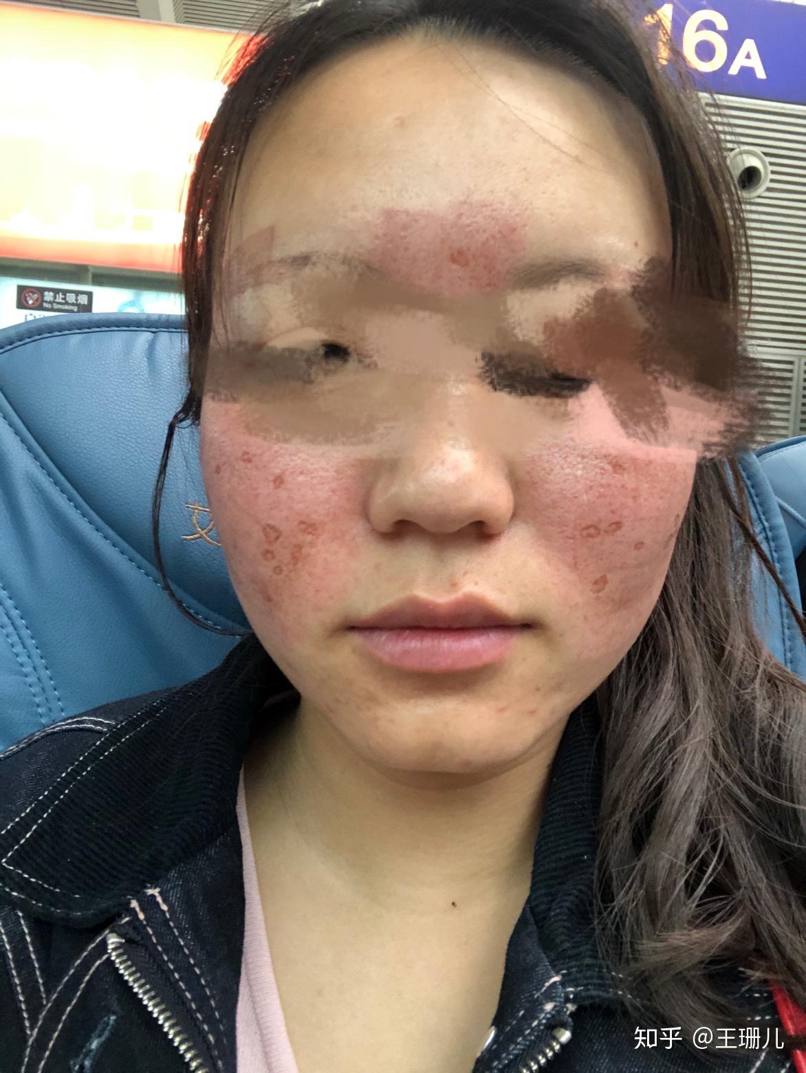 点阵激光治疗体验