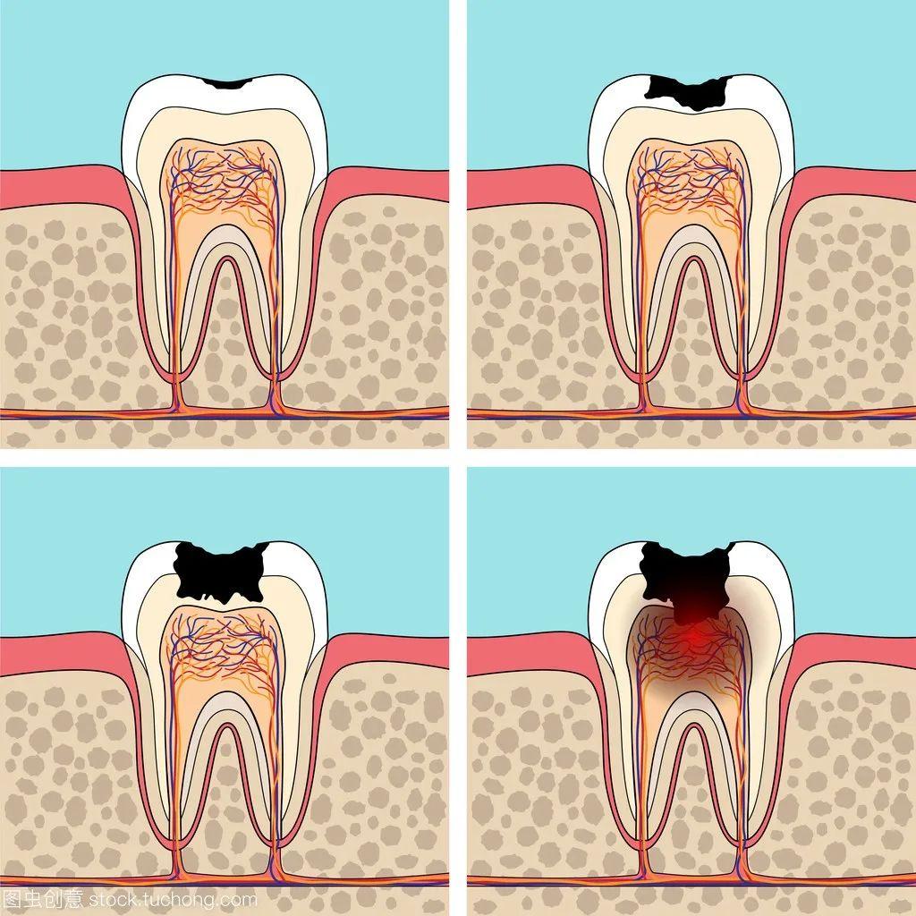 蛀牙并非几天就可以形成的,从初期龋到形成龋洞通常需要1年半左右的