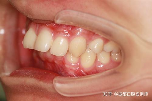 可是现在发现其实龅牙也分骨性龅牙和牙性龅牙,不知道怎么区分吧?