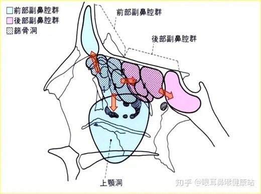 3.鼻竇炎的擴展方式蝶竇:位置最深,常規檢查不易,發病率最低.