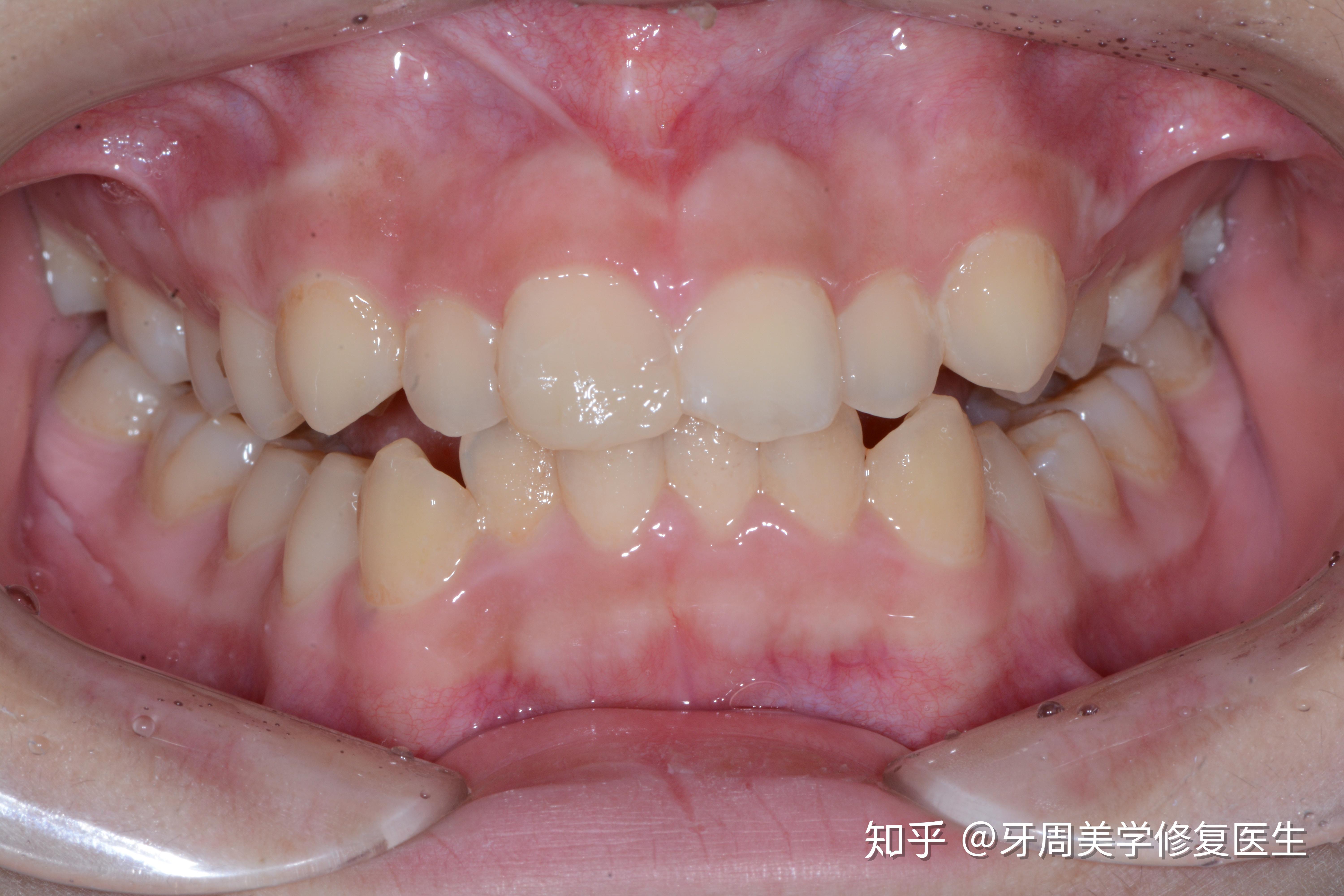 前牙美容树脂修复