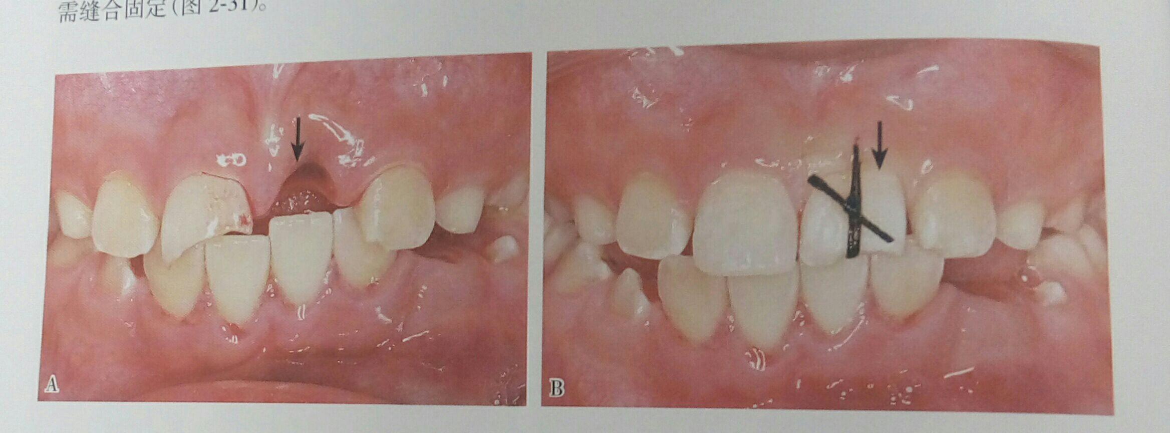 前牙外伤一周美塑树脂补牙一例 - 知乎