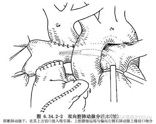 【wilson的医学杂谈】左心发育不良,norwood术式,fontan手术经典应用