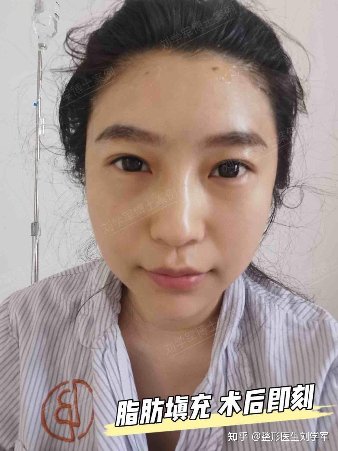 27岁上北京做了面部脂肪填充，术后30天真实反馈，太“惊艳”了！ - 知乎