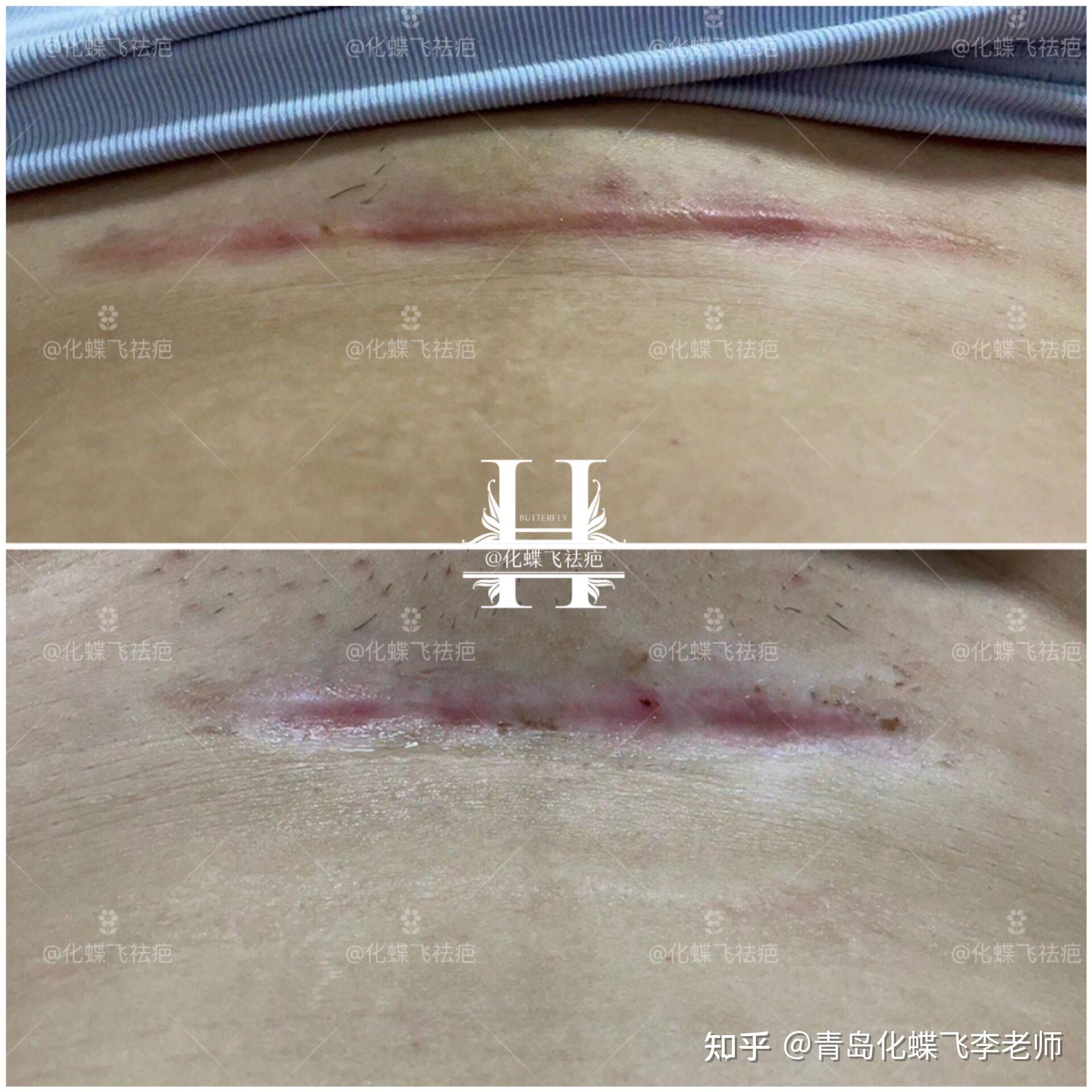 剖腹產增生疤痕修復