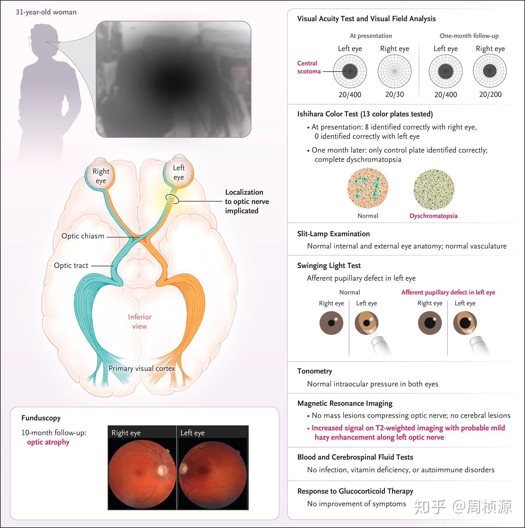 nejm2019case21