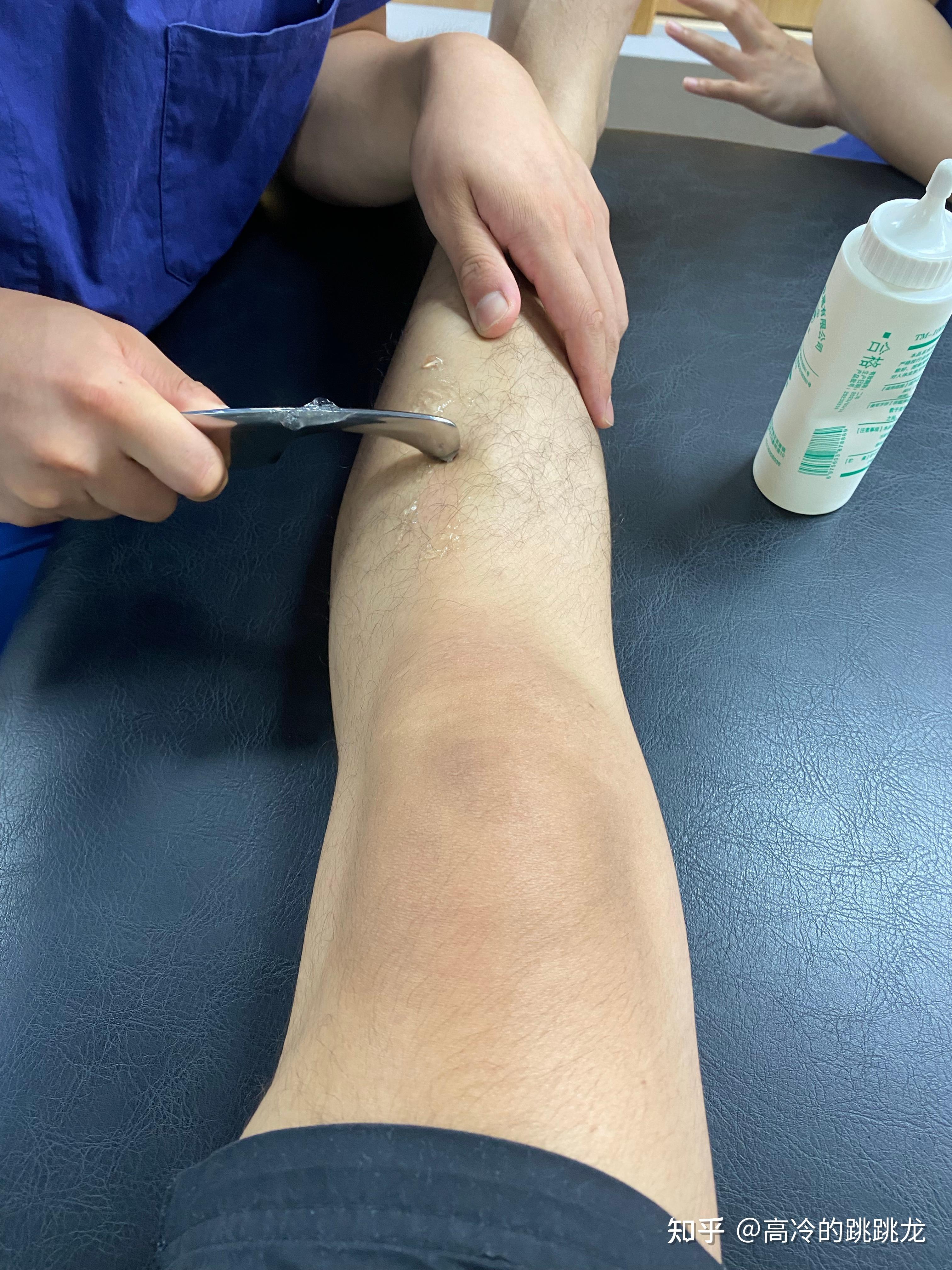 脚踝骨折取钢板的过程