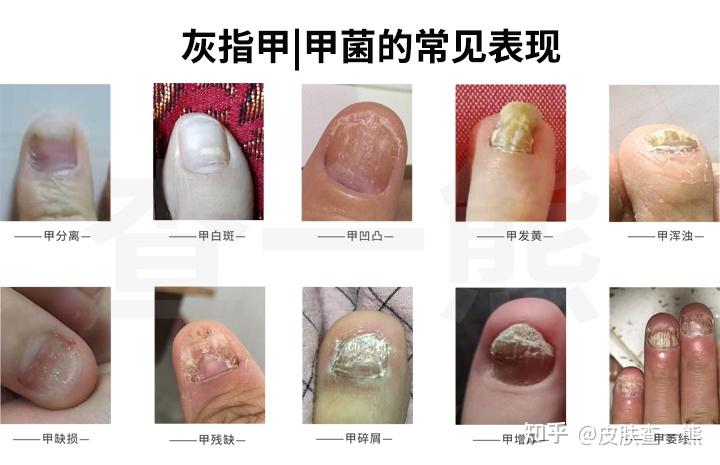 【老查说】灰指甲|甲菌VS甲营养不良 - 知乎