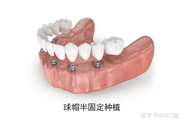 牙体、牙列缺损与牙列缺失的区别! - 知乎