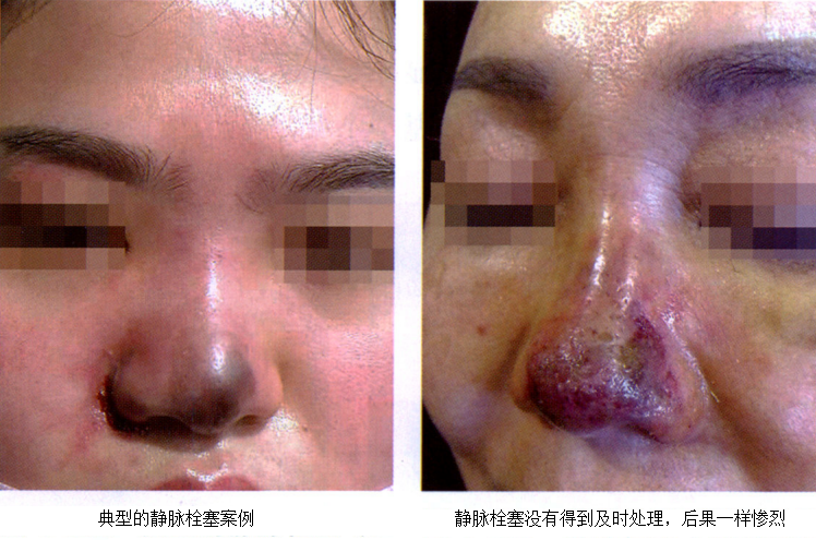 注射后可能会马上出现局部发白,地图样变化或花斑样变化,而且动脉栓塞