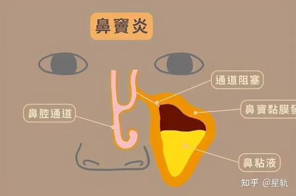 鼻窦炎的病因,鼻窦炎有哪些症状?——唐山五官医院 - 知乎