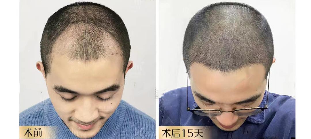 植发要怎么选择(植发怎么选择医院或者机构)