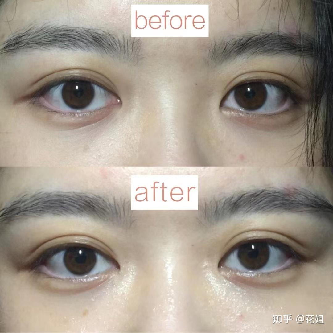 上千元的极萌熨斗美容仪能代替医美吗?实测眼部细纹/法令纹/v脸紧致 - 知乎