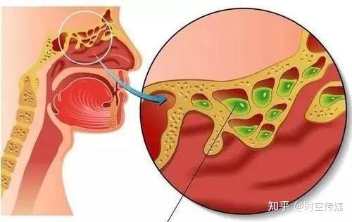 點石師爺王永月醫生談腺樣體肥大和鼻竇炎的關係