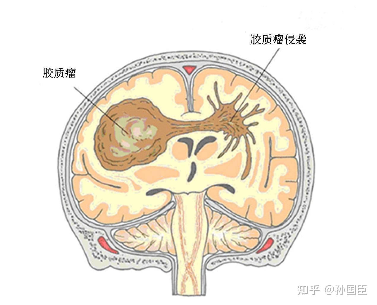 膠質瘤是怎麼形成的? - 知乎