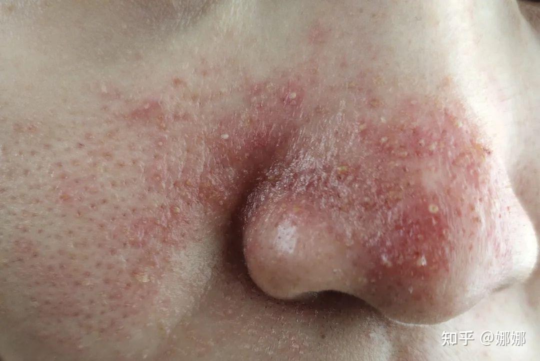 酒糟濞怎么治疗求推荐方法