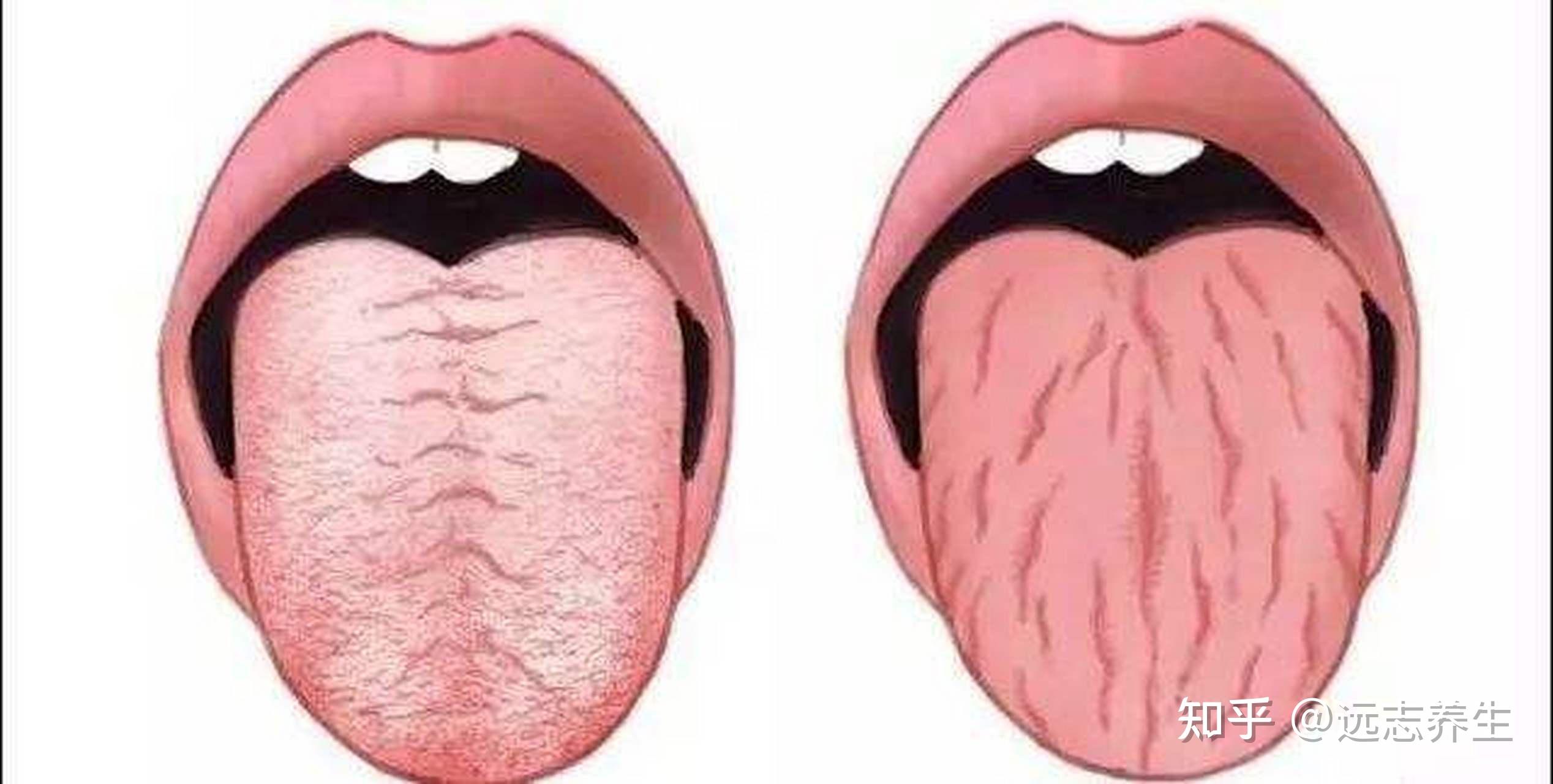 舌头上有裂痕 - 知乎