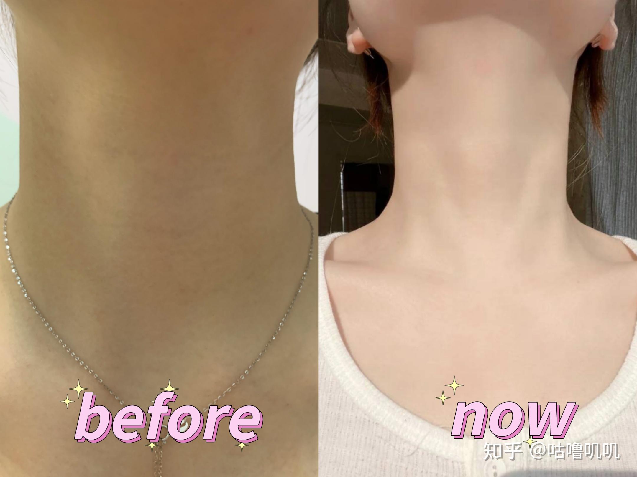 身体乳有助于消除颈纹吗(身体乳有助于消除颈纹吗女生)