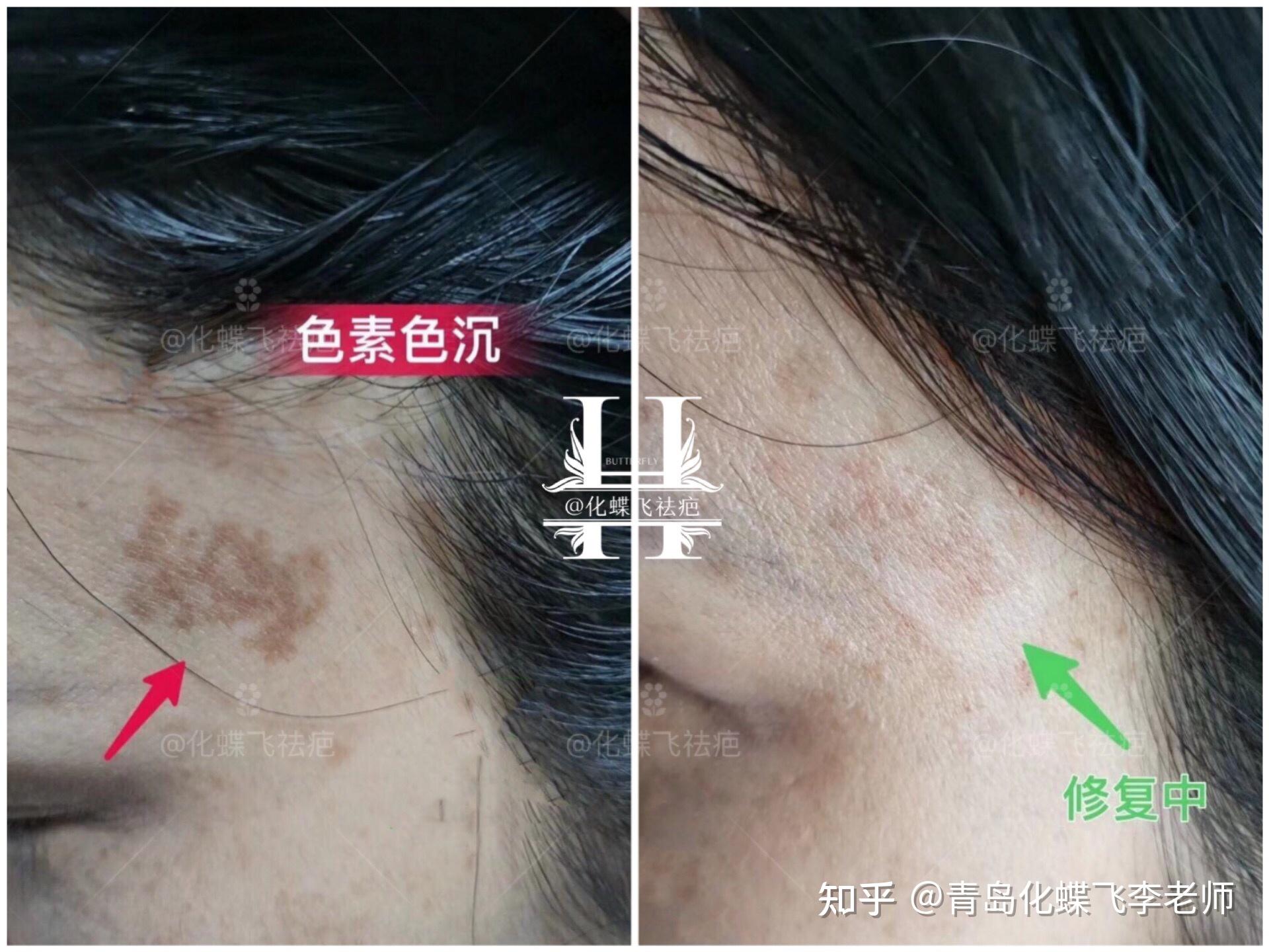 面部疤痕色素沉淀怎么消除 能用激光去除吗？ | 说明书网