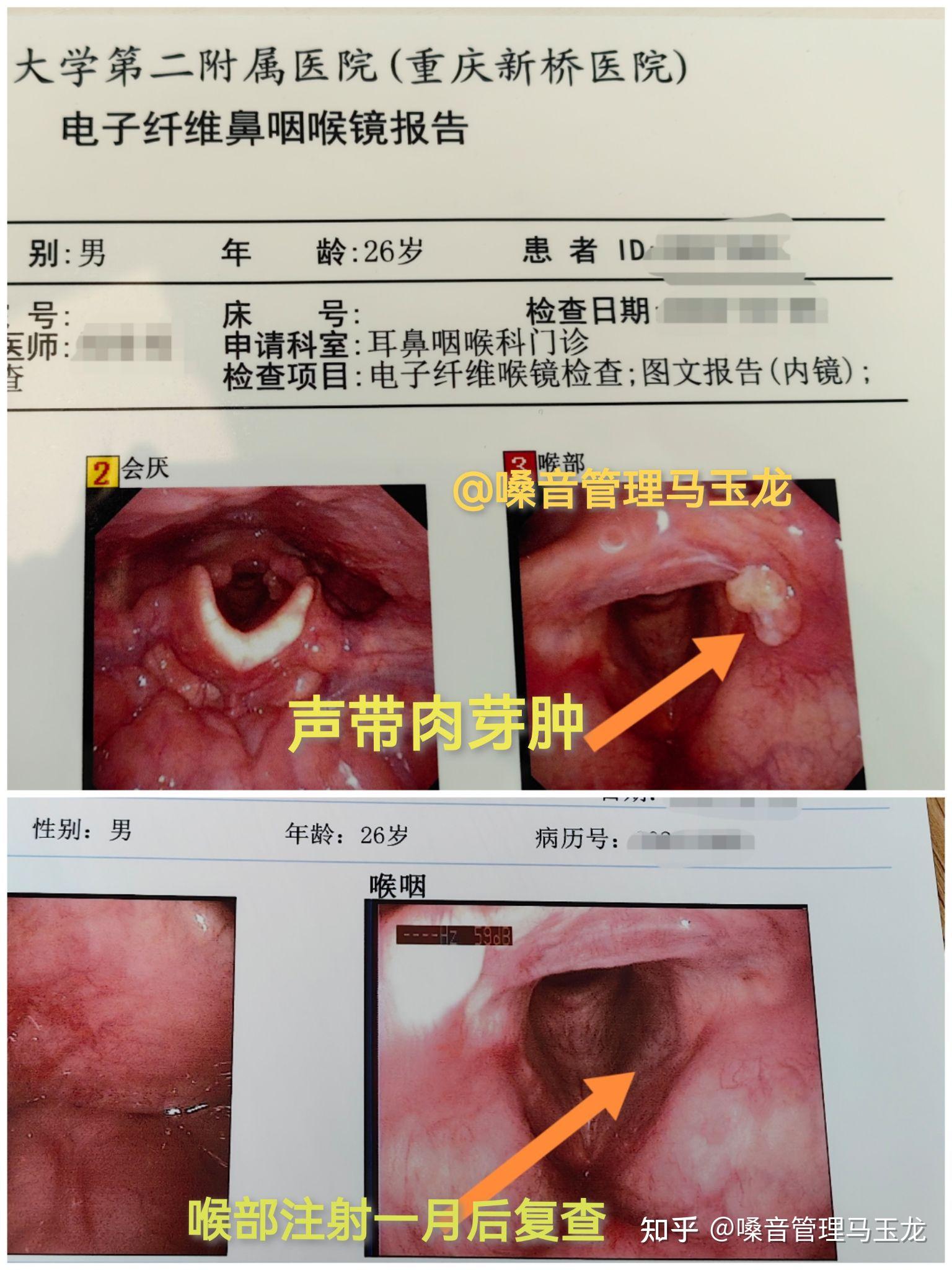 声带肉芽肿不手术可以吗?
