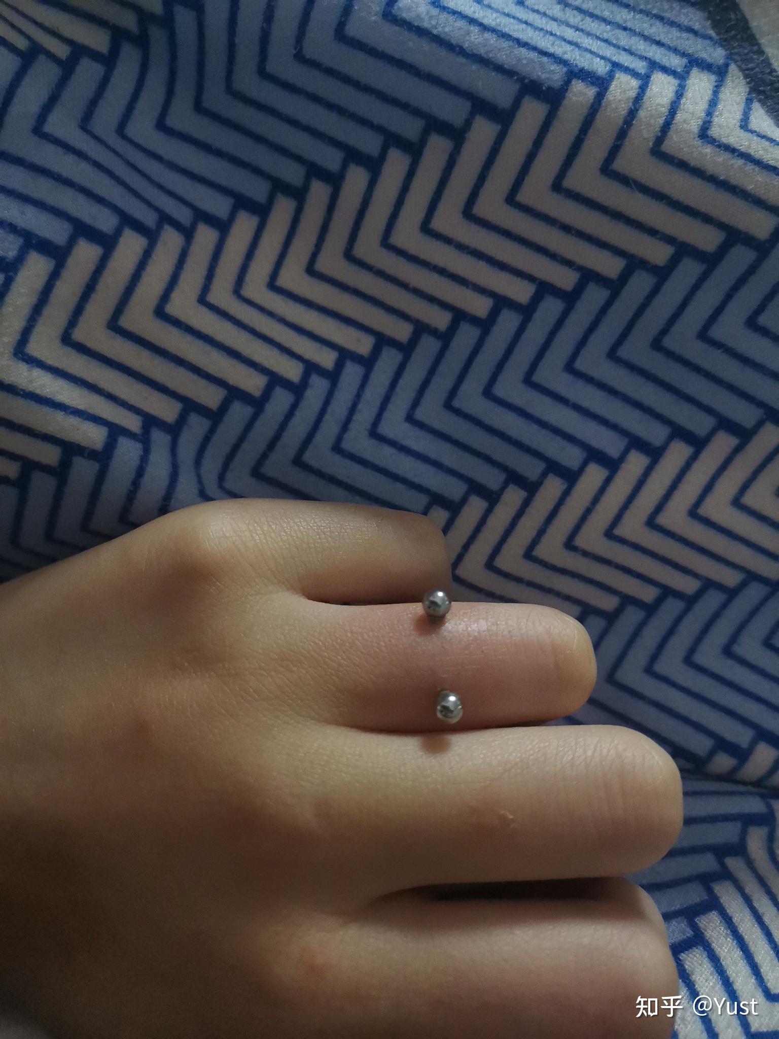 手指钉orward helix恢复记录