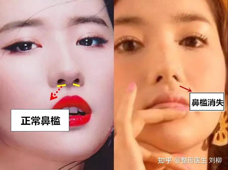 鼻槛是鼻部重要的解剖结构与美学结构,尤其是在唇裂