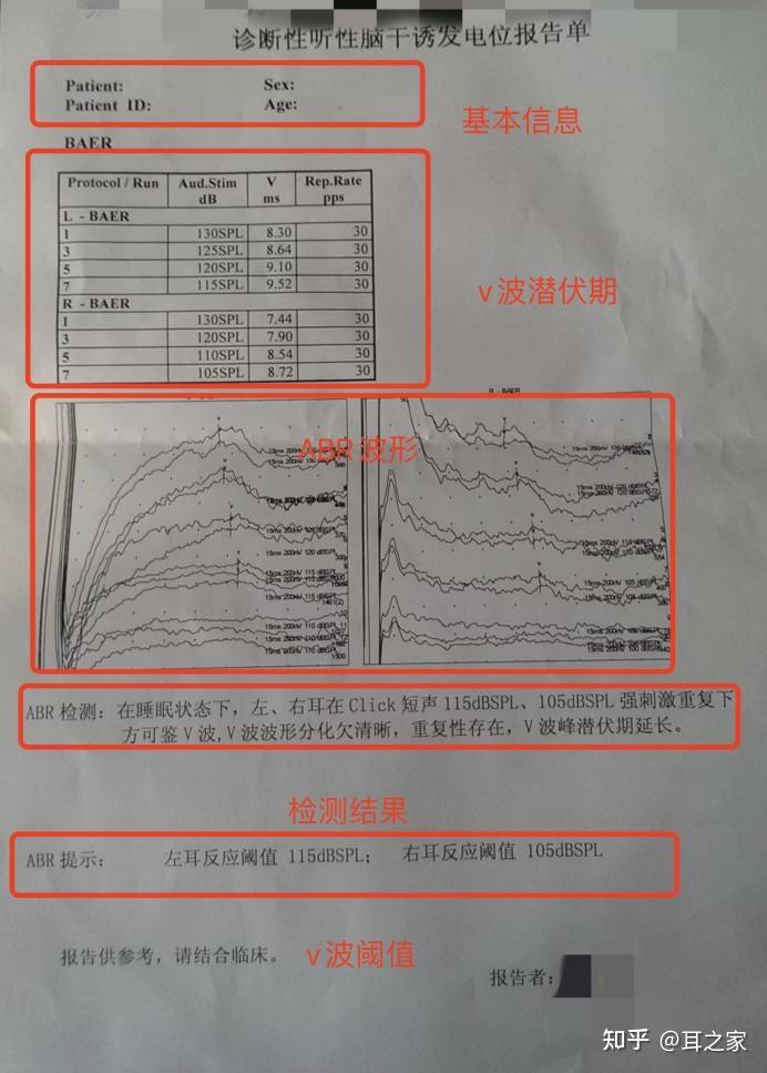 睡着做的那项听力测试(ABR),结果怎么看? - 知乎