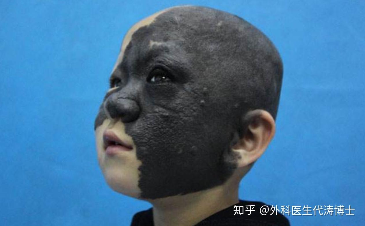 北京丽合医疗美容医院胎记科：腿上长黑毛痣装扩张期需要全麻吗 - 哔哩哔哩