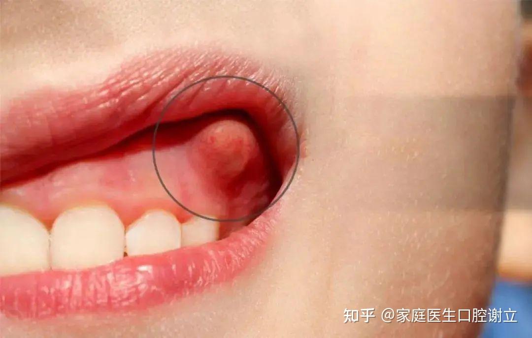 牙龈上长脓包的原因 - 知乎