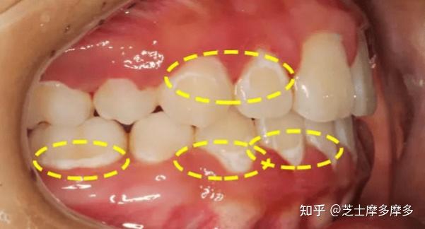 正畸后牙齿脱矿怎么办?还有救吗? - 知乎