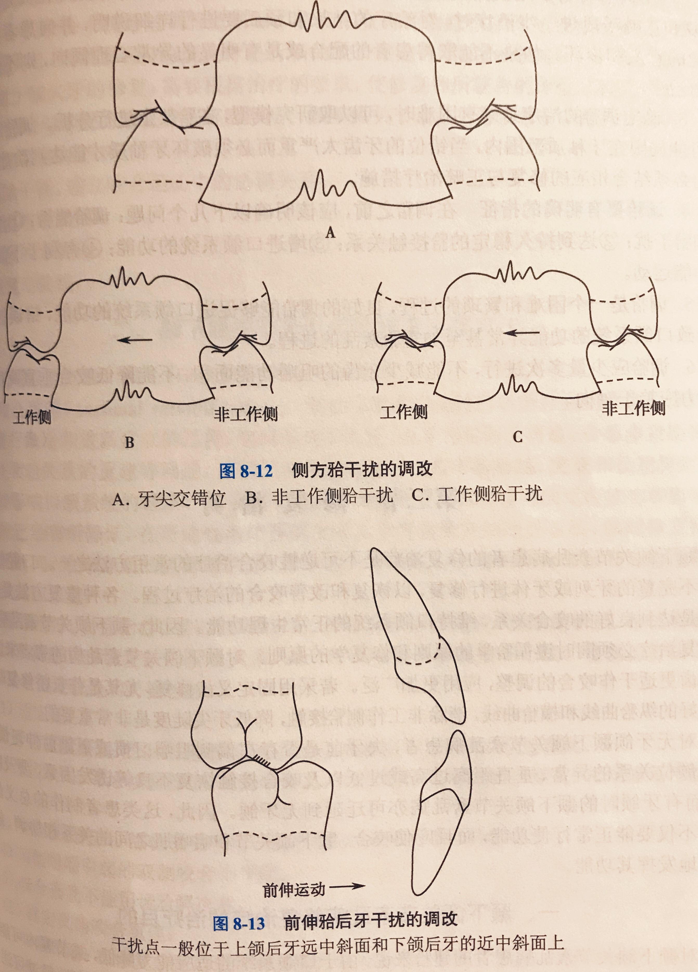 咬合治疗天然牙列的调牙合