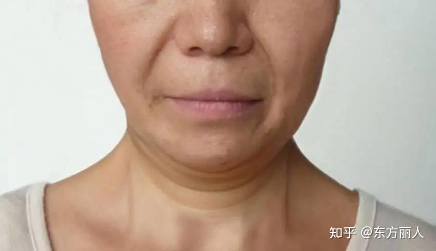 咬肌脸和脂肪脸分别如何处理