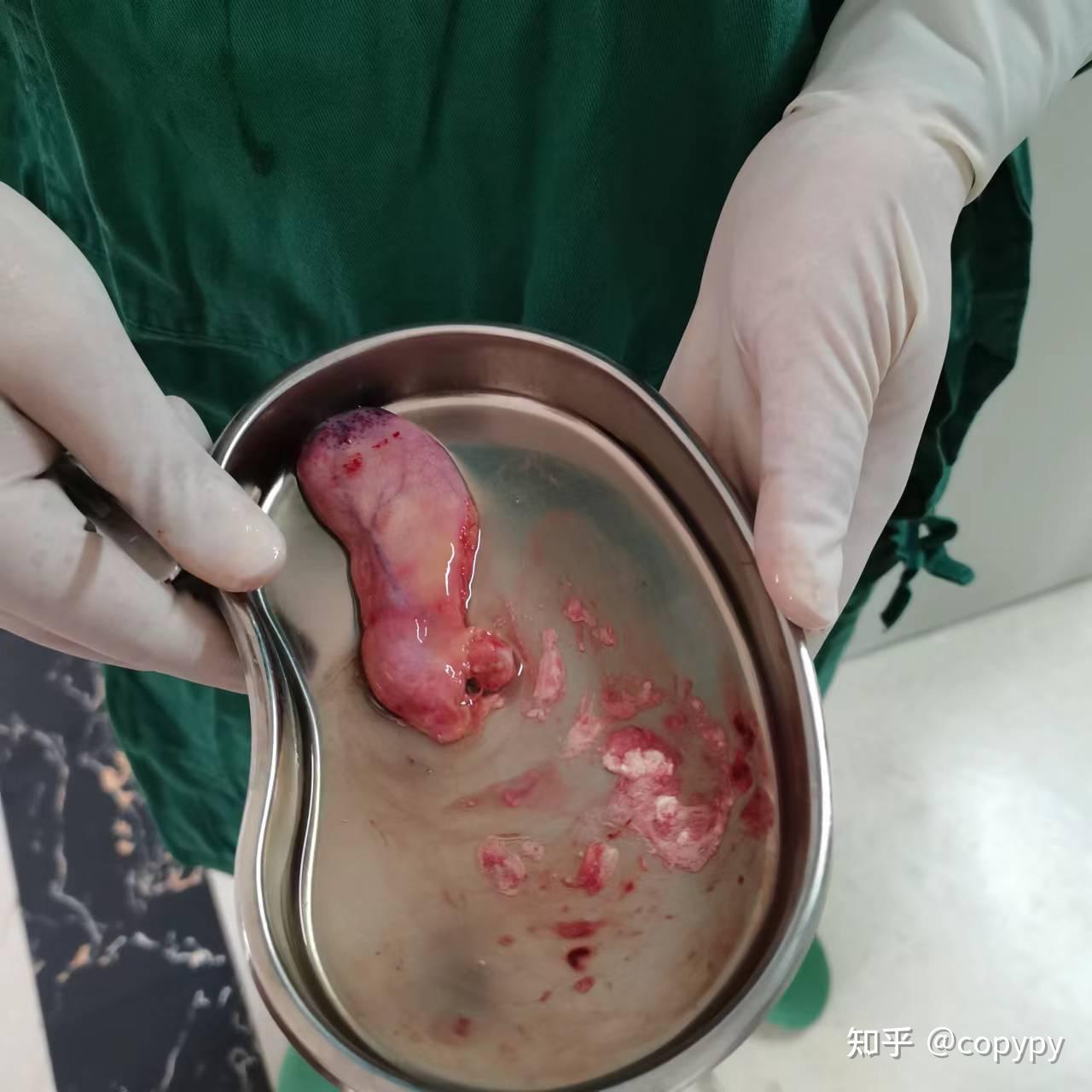 15岁胆囊结石切除手术是什么体验?