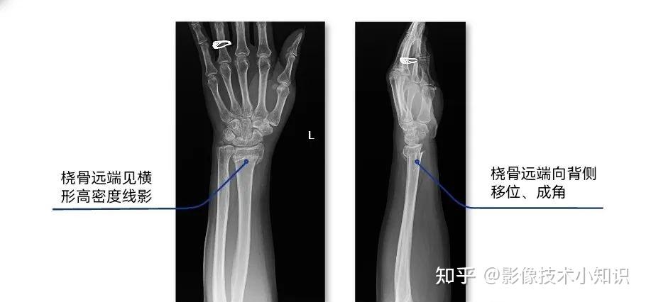 骨折影像表现(1) - 知乎