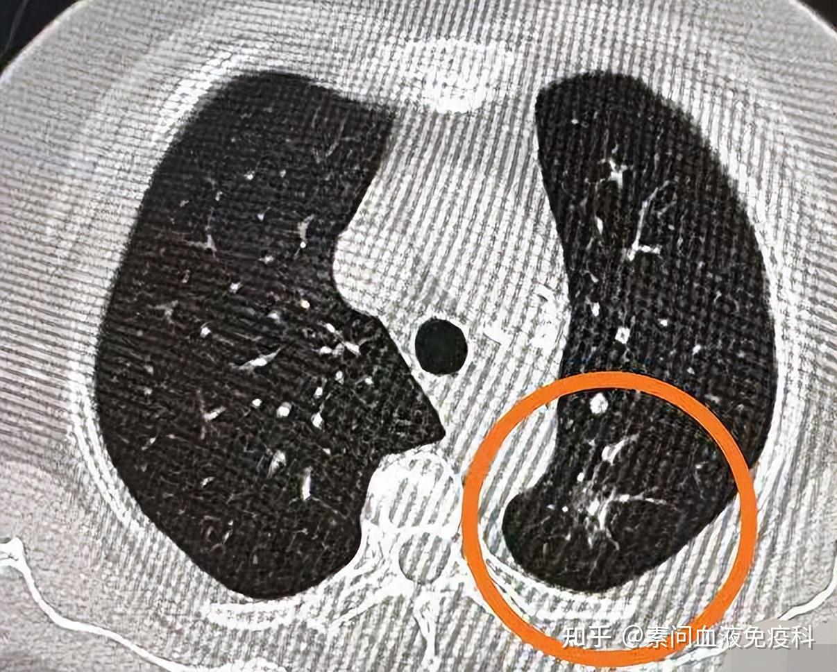 磨玻璃結節老中醫一方兩月結節消失不見