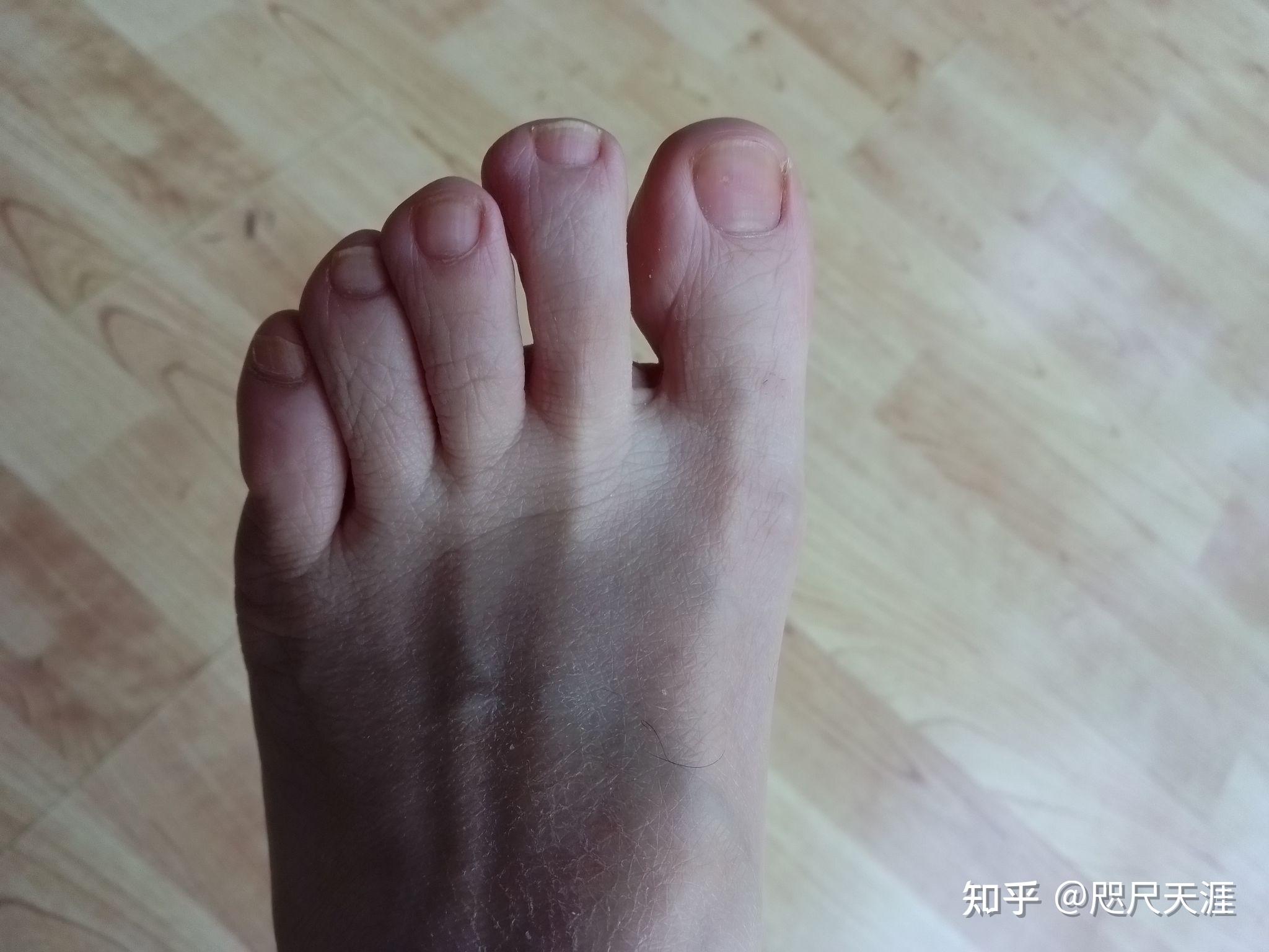 民间土方治疗灰指甲——不间断实践全治疗过程发图(100%原创真实不打